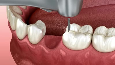A dental drill is being used on a lower molar tooth in a persons mouth, with the tongue and surrounding teeth visible.