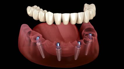 3D illustration showing a set of artificial teeth above a lower jaw model with four dental implants inserted into the gum, demonstrating a full arch implant-supported denture.